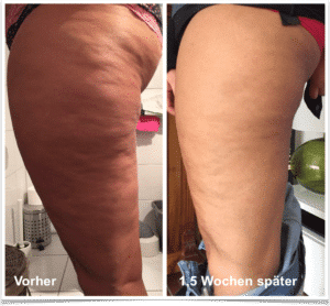 dr juchheim byebycellulite ergebnis beine