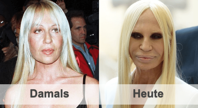 Donnatella Versace damals heute botox