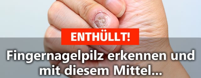 fingernagelpilz hand