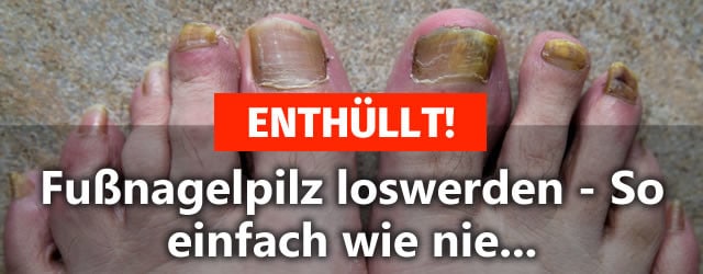 fußnagelpilz füße