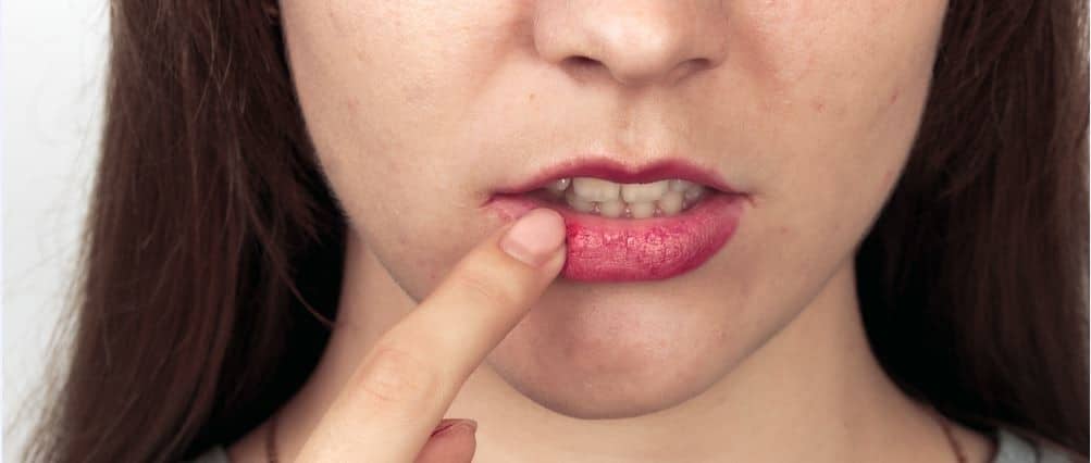 teebaumöl gegen herpes