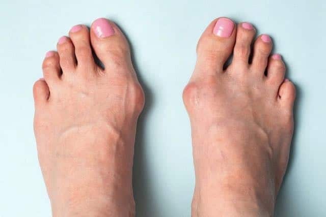 Hallux Valgus